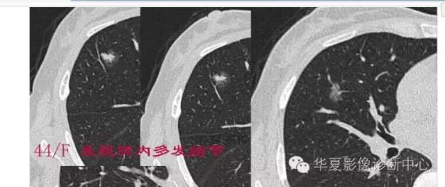 磨玻璃结节良恶性影像分析策略