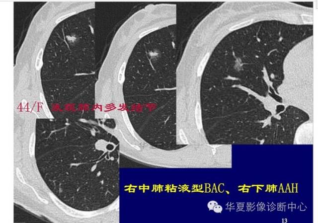磨玻璃结节良恶性影像分析策略