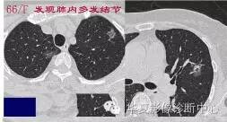 磨玻璃结节良恶性影像分析策略