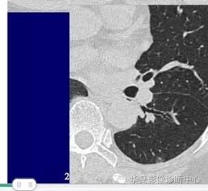 磨玻璃结节良恶性影像分析策略