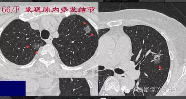 磨玻璃结节良恶性影像分析策略