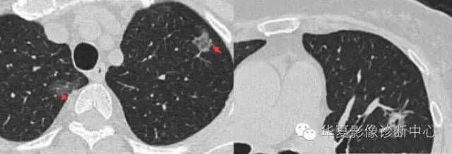 磨玻璃结节良恶性影像分析策略