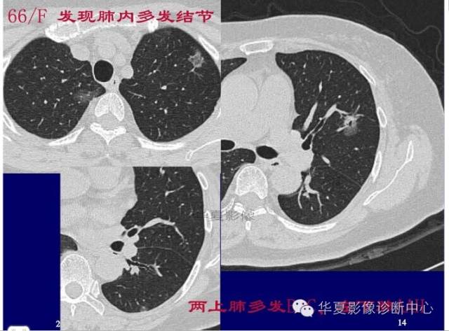 磨玻璃结节良恶性影像分析策略