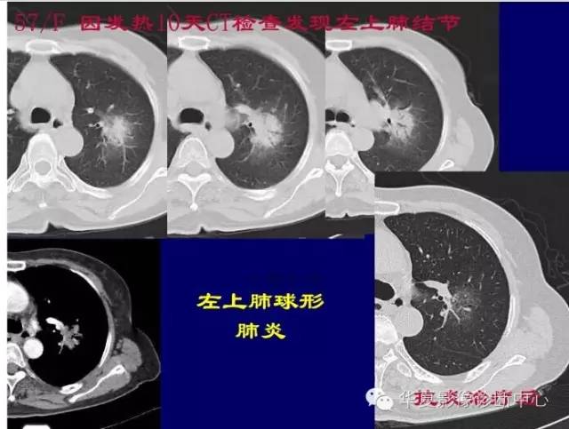 磨玻璃结节良恶性影像分析策略