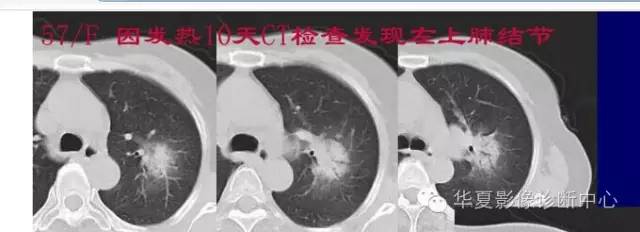 磨玻璃结节良恶性影像分析策略