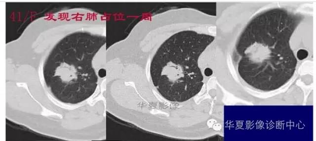 磨玻璃结节良恶性影像分析策略