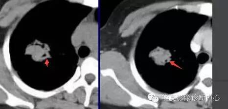 磨玻璃结节良恶性影像分析策略