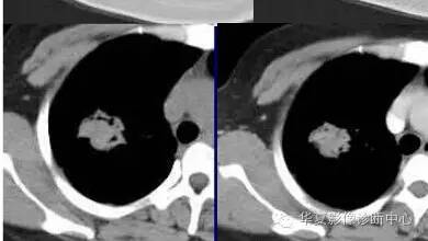 磨玻璃结节良恶性影像分析策略