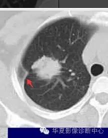 磨玻璃结节良恶性影像分析策略