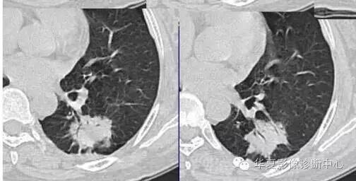 磨玻璃结节良恶性影像分析策略
