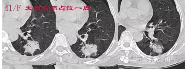 磨玻璃结节良恶性影像分析策略