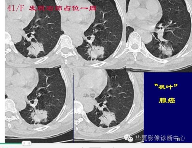 磨玻璃结节良恶性影像分析策略