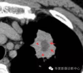 磨玻璃结节良恶性影像分析策略