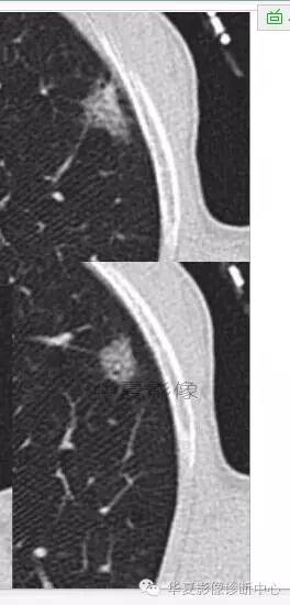 磨玻璃结节良恶性影像分析策略