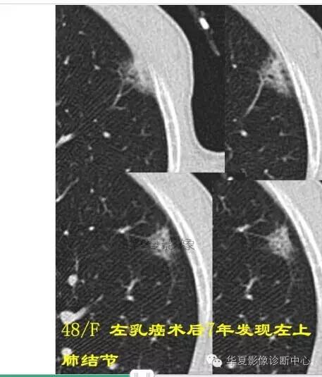 磨玻璃结节良恶性影像分析策略