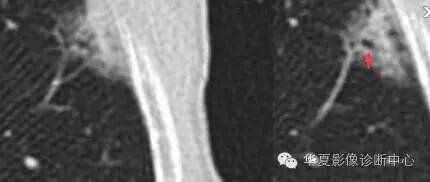 磨玻璃结节良恶性影像分析策略