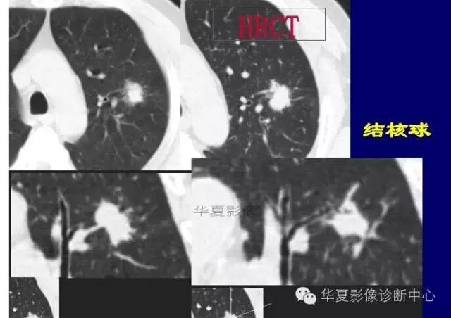 磨玻璃结节良恶性影像分析策略