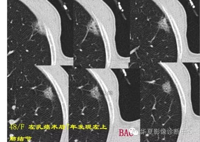 磨玻璃结节良恶性影像分析策略