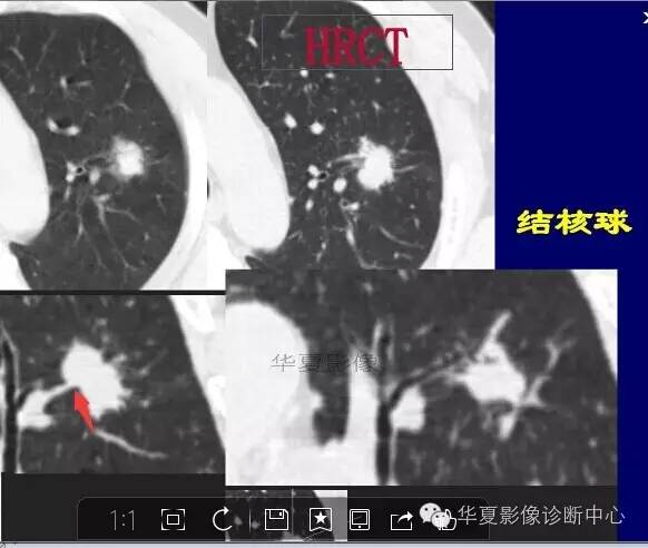磨玻璃结节良恶性影像分析策略