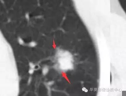 磨玻璃结节良恶性影像分析策略