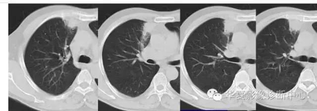 磨玻璃结节良恶性影像分析策略
