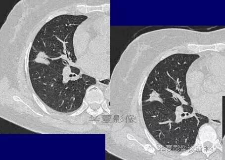 磨玻璃结节良恶性影像分析策略