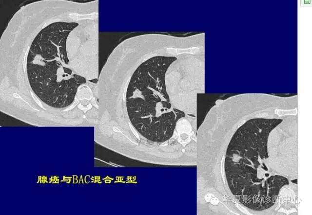 磨玻璃结节良恶性影像分析策略
