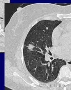 磨玻璃结节良恶性影像分析策略