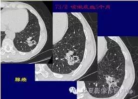 磨玻璃结节良恶性影像分析策略