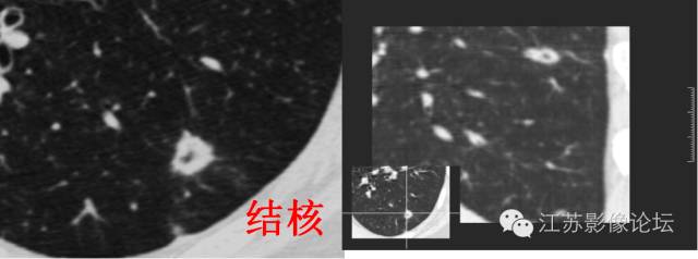 肺部结节的CT鉴别特征