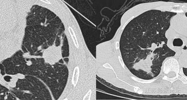 肺部结节的CT鉴别特征