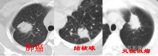 肺部结节的CT鉴别特征