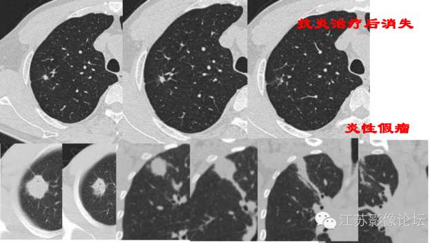 肺部结节的CT鉴别特征