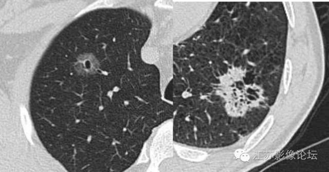 肺部结节的CT鉴别特征