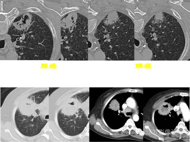 肺部结节的CT鉴别特征