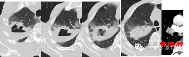 肺部结节的CT鉴别特征