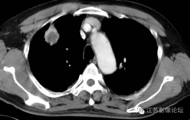 肺部结节的CT鉴别特征