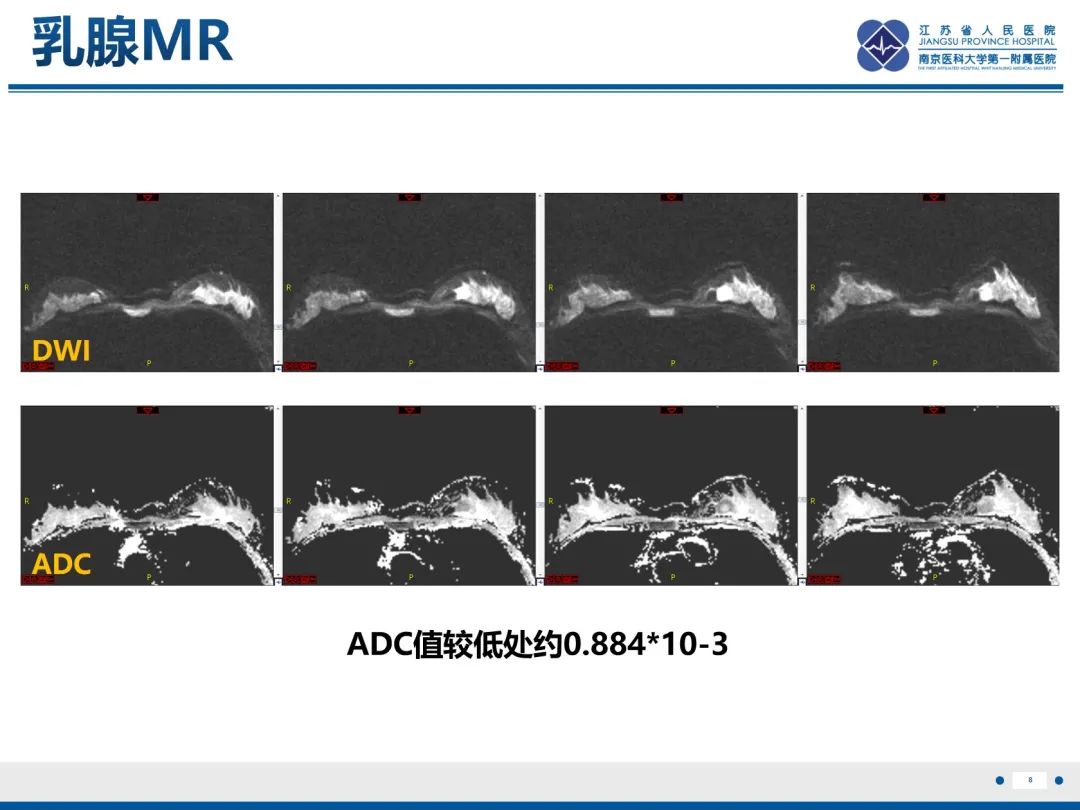 【PPT】三阴性乳腺癌-9