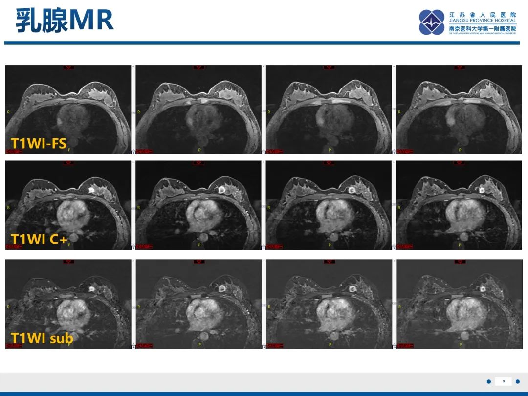 【PPT】三阴性乳腺癌-10