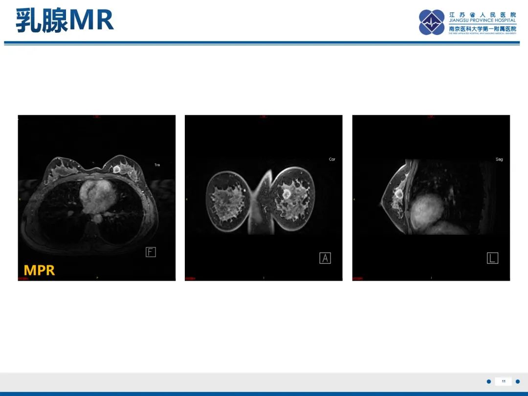 【PPT】三阴性乳腺癌-12