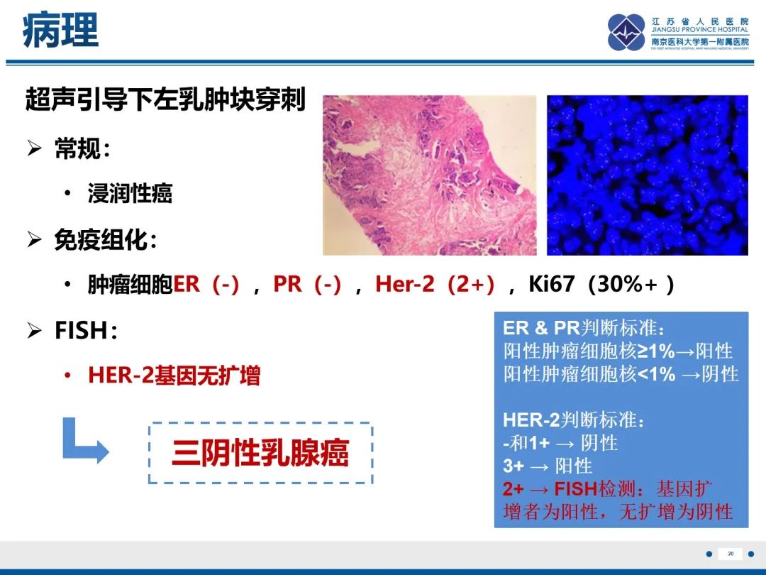 【PPT】三阴性乳腺癌-21