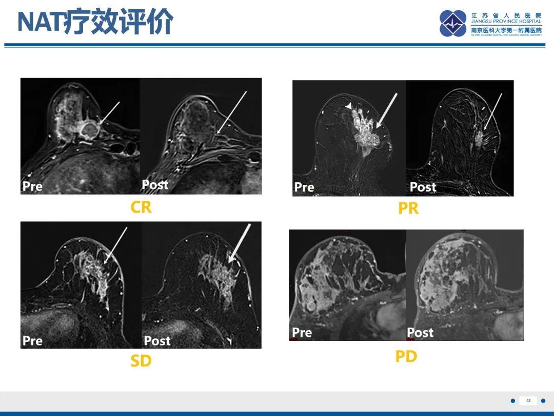 【PPT】三阴性乳腺癌-33