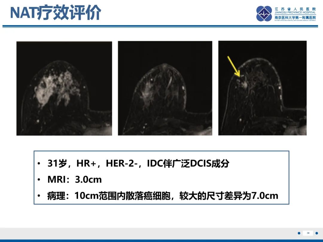 【PPT】三阴性乳腺癌-35