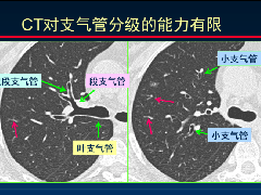 <b>HRCT对肺结核细节的观察进展</b>