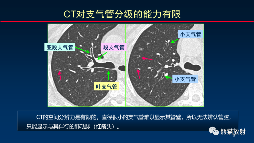 【PPT】HRCT对肺结核细节的观察进展-5