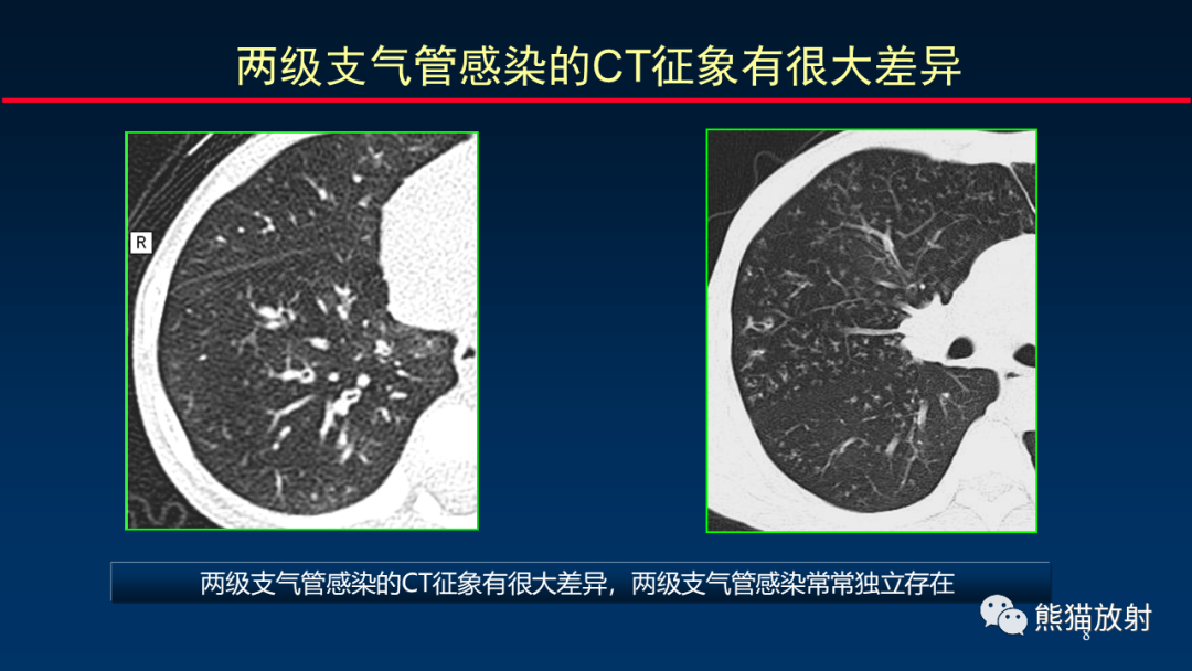 【PPT】HRCT对肺结核细节的观察进展-8