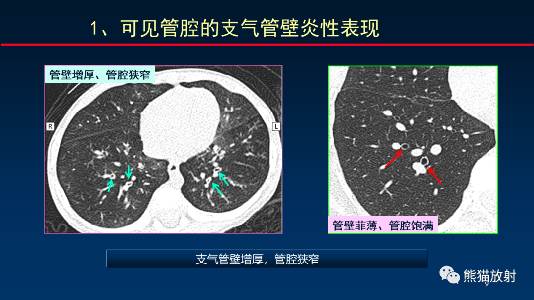 【PPT】HRCT对肺结核细节的观察进展-9
