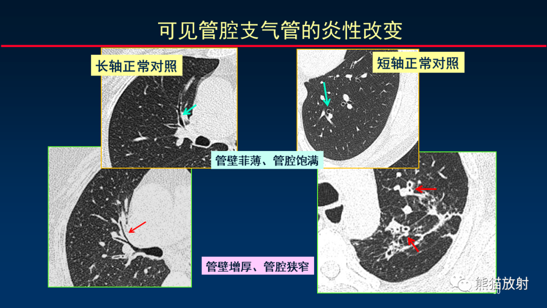 【PPT】HRCT对肺结核细节的观察进展-10