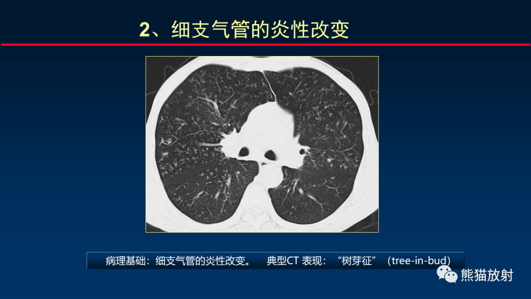 【PPT】HRCT对肺结核细节的观察进展-11