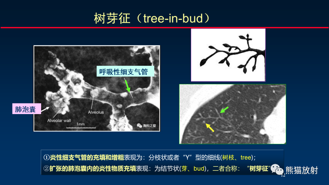 【PPT】HRCT对肺结核细节的观察进展-12